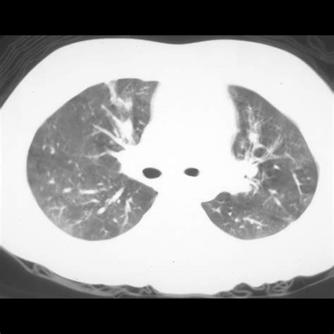 Toddler with wheezing | Pediatric Radiology Case | Pediatric Imaging