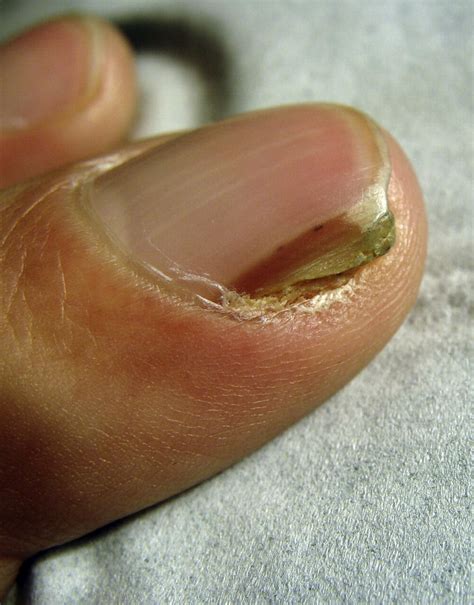 A Retrospective Study Of Squamous Cell Carcinoma Of The Nail Unit