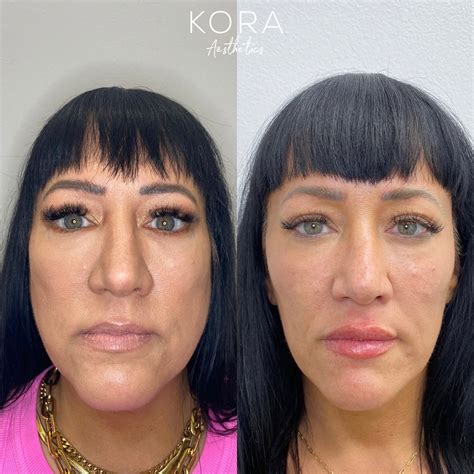 Before And After Botox Photo Gallery Remarkable Results