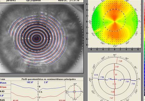 Tipos de topografía corneal y sus aplicaciones médicas