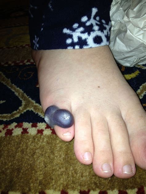 So I got some warts frozen off... : r/WTF