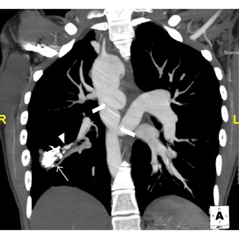 A And B Coronal CT Pulmonary Angiography MIP Maximum Intensity