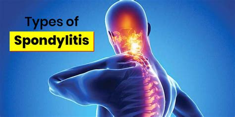 What Are The Different Types of Spondylitis? Learn About 3 Major Types In This Article ...