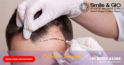 Fue Hair Transplant In Lucknow Smile Glo