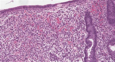 Proliferative Endometrium Ottawa Atlas Of Pathology