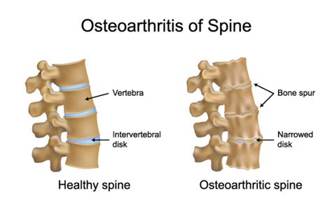 Spinal Arthritis Symptoms Causes And Treatment Orthopedic Blog