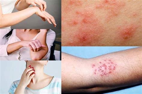 Neurodermatitis Kelainan Kulit Akibat Kondisi Psikis Lentera Sehat