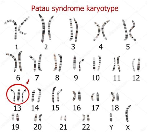 Patau Syndrome Karyotype Stock Vector Image By Zuzanaa