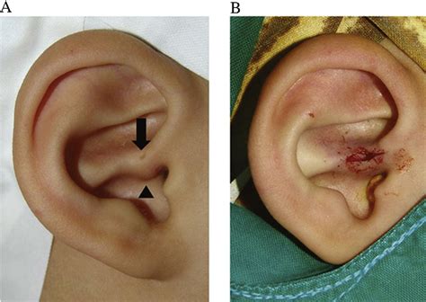 Preauricular Cyst Excision