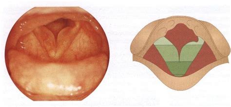 Хронический ларингит (laryngitis chronica)