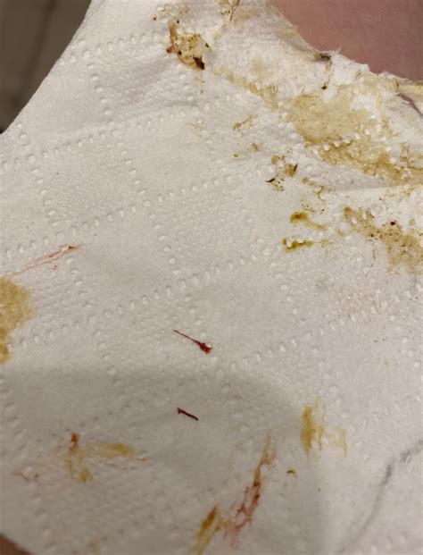 Bloody mucus in stool : r/poop
