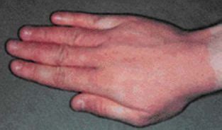 Крапивница и отек Квинке