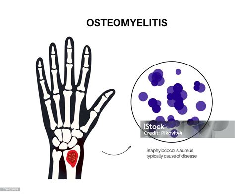 Osteomielitis Lengan Ilustrasi Stok Unduh Gambar Sekarang Anatomi