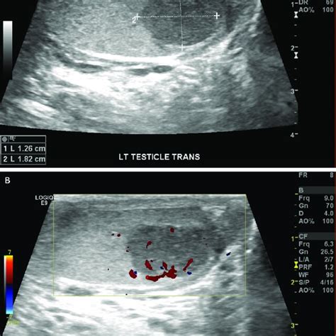 Representative Ultrasound Images Of The Testicular Mass A The Mass