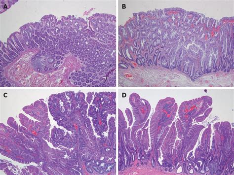 Showing 4 Serrated Polyp Subtypes A Microvesicular