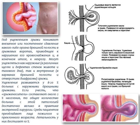 Паховая грыжа: причины, симптомы и эффективное лечение