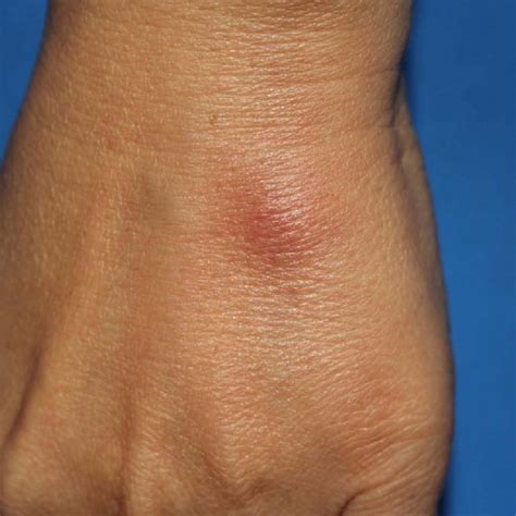 Erythema Nodosum At The Dorsum Of The Left Hand In A Patient Diagnosed