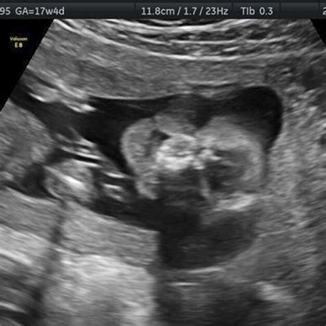 Stillborn Face Demonstrates Cleft Lip And Palate Download Scientific Diagram