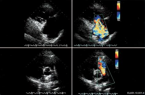carcinoid heart disease semantic scholar