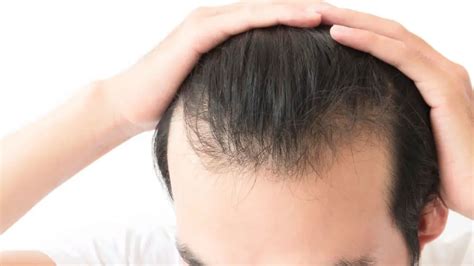 Does Creatine Cause Hair Loss and Baldness? [Guide]