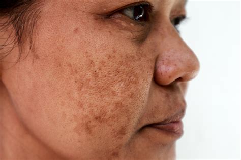 Melasma And Pigmentation Aura Dermatology