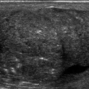 Pdf Sonography Of The Scrotum