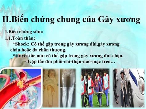 B2 dc gay xuong BỆNH NGOẠI KHOA PPT
