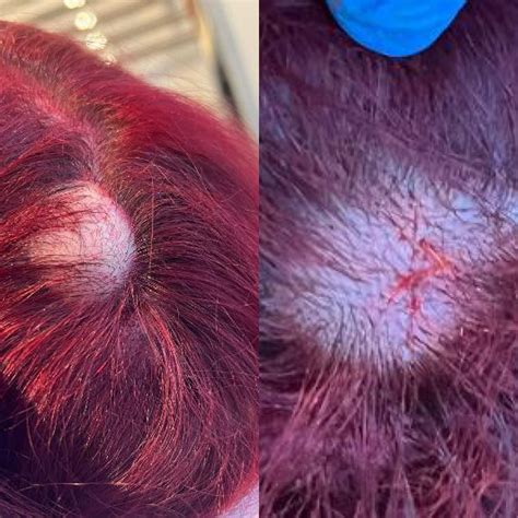 Sebaceous Cysts, Epidermoid and Pilar Cysts | InSkin