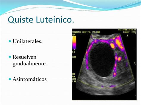 Ppt Placenta Previa Powerpoint Presentation Free Download Id7720537