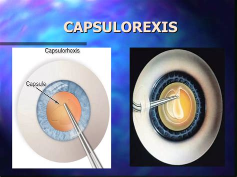 Enfermeria En Cirugia Oftalmologica De Facoemulsificacion CICAT SALUD