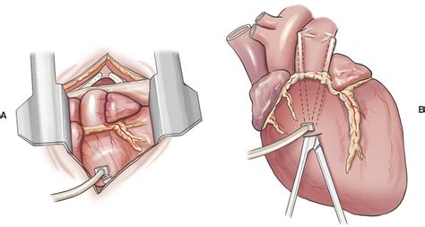 Pericardiectomy