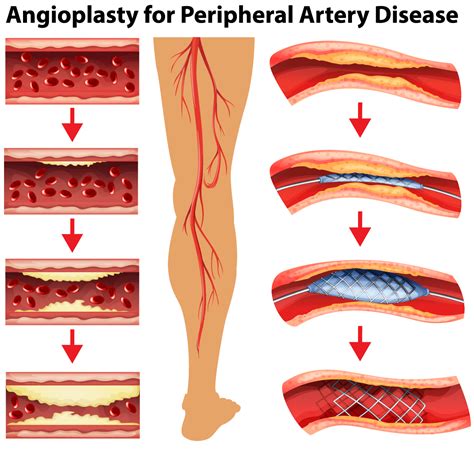 peripheral artery disease symptoms screening treatment