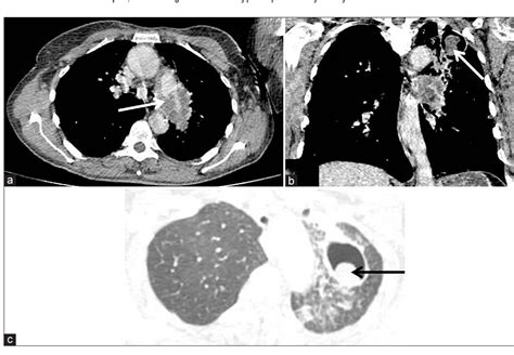 Figure 1 From Rare Histological Subtype Of Pulmonary Artery Intimal