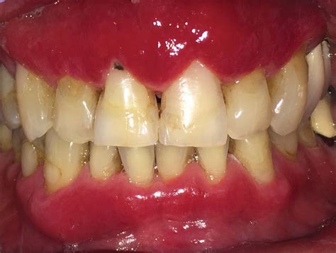 Severe Gingival Swelling And Erythema Mdedge Dermatology