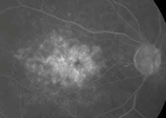 Edema Macular S Ntomas Causas Y Tratamiento Rea Oftalmol Gica