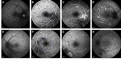 Figure 3 from Syndrome des taches blanches évanescentes associé à une