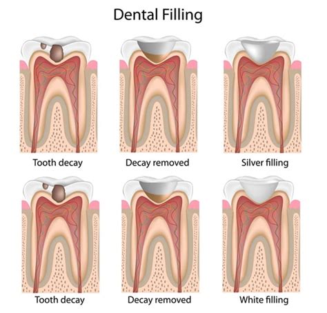 Restoration of Tooth Decay | Martin Family Dentistry