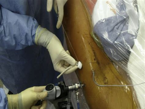 Arthroscopic Labral Reconstruction Of The Hip Using Iliotibial Band