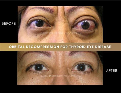 Thyroid Eye Disease Photos - Plastic Eye Surgery Associates