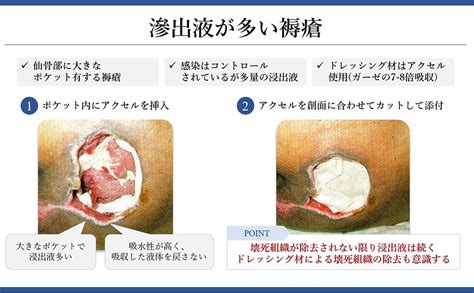 褥瘡を科学する