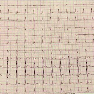 12 Lead Electrocardiogram Showing Atrial Tachycardia With A Heart Rate