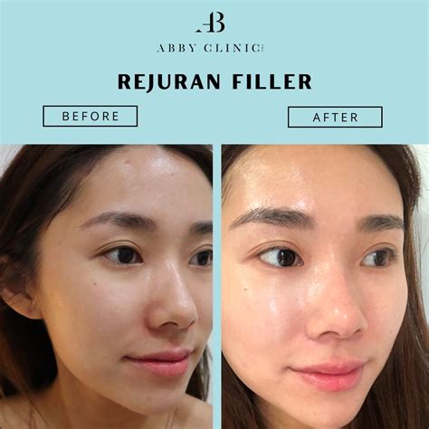 Rejuran healer - Dr Abby Clinic
