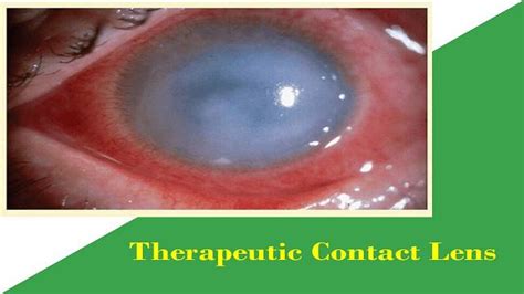 Therapeutic Bandage Contact Lenses Therapeutic