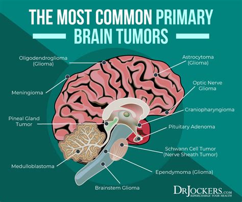 Brain Cancer: Natural Strategies to Help the Fight - DrJockers.com