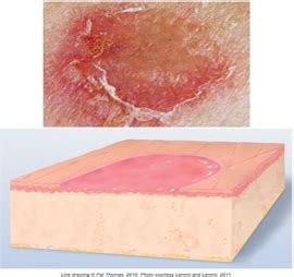 Module Part Ulcers And Other Vascular Disorders Flashcards Quizlet