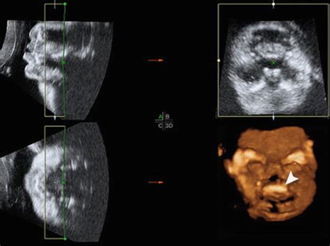 Cleft Lip D Ultrasound