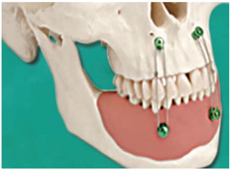 fixation  maxillofacial surgery  present  future  narrative