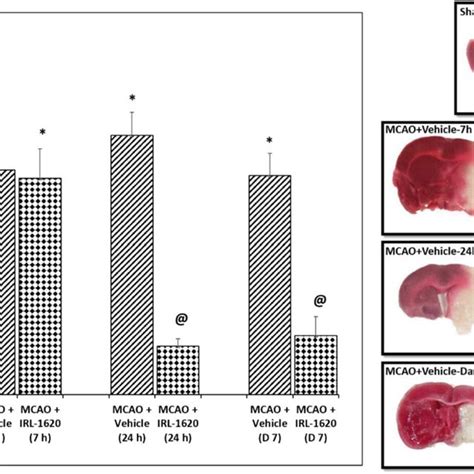 Effect Of Irl On Infarct Volume In Mcao Rats Mm Coronal