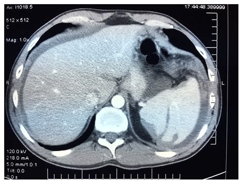 Unusual Radiologic Presentations Of Malignant Peritoneal Mesothelioma