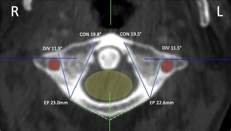 Axial Ct Image Of C1 With Landmarks And Mean Values Shown Ep Screw Download Scientific